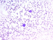 Marrow Changes in Renal Osteodystrophy - 1.