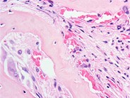 Marrow Changes in Renal Osteodystrophy - 5.