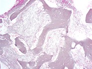 Marrow Changes in Renal Osteodystrophy - 7.