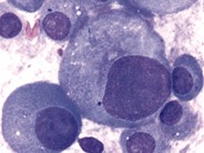 Multiple Myeloma - 2.