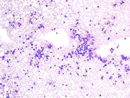 Kostmann's Syndrome - 3.