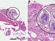 Schistosomal eggs identified on bone marrow biopsy