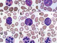 Nuclear hypersegmentation of neutrophils, eosinophils, and basophils due to hydroxycarbamide (hydroxyurea)
