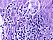 Mycosis Fungoides - 4.