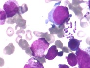 Bone marrow aspirate showing Penicillium marneffei