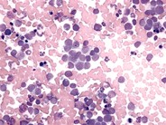 Retinoblastoma - 2.