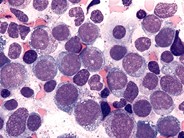 Pure Erythroid Leukemia - 1.