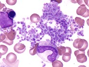 Platelet Clump - 1.