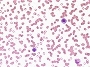 plasma-cell-leukemia-1