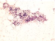 Hypocellular Bone Marrow Following Therapy - 1.