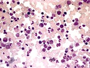 Normal Bone Marrow Aspirate - 1.