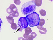 Pseudo Chediak-Higashi Granules - 1.
