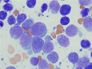 Acute Monoblastic and Monocytic Leukemia - 4.