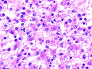 Sinus histiocytosis with massive lymphadenopathy - 3.