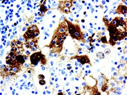 Sinus histiocytosis with massive lymphadenopathy - 6.