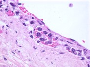 Intravascular Large Cell Lymphoma - 2.