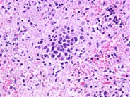 Intravascular Large Cell Lymphoma - 4.