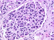 Intravascular Large Cell Lymphoma - 6.