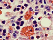 Hemophagocytosis: Bone Marrow Biopsy of Patient With Hepatitis C and Acute EBV Infection - 1.