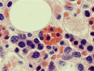 Hemophagocytosis: Bone Marrow Biopsy of Patient With Hepatitis C and Acute EBV Infection - 2.