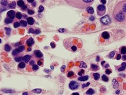 Hemophagocytosis: Bone Marrow Biopsy of Patient With Hepatitis C and Acute EBV Infection - 4.