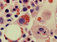 Hemophagocytosis: Bone Marrow Biopsy of Patient With Hepatitis C and Acute EBV Infection - 5.