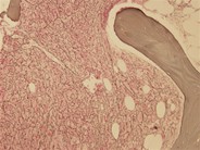 Myelofibrosis and Megakaryocyte Clustering - 1.