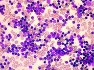 CLL Marrow Aspirate - 1.