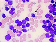 CLL Marrow Aspirate - 3.