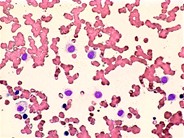 Reactive Histiocytes in the Peripheral Blood - 1.