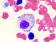 Reactive Histiocytes in the Peripheral Blood - 3.