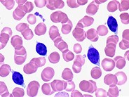 Splenic Marginal Zone Lymphoma With Villous Lymphocytes – Peripheral Blood - 3.