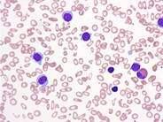 Hairy Cell Leukemia Variant - 1.