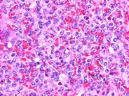 Hairy Cell Leukemia Variant - 10.