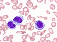 Hairy Cell Leukemia Variant - 2.