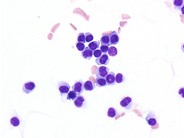 Hairy Cell Leukemia Variant - 3.