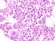 Hairy Cell Leukemia Variant - 5.