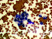 Pseudoneutropenia in a patient of systemic lupus erythromatosis with coomb’s positive immune hemolytic anemia - 1.