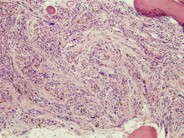 Bone Marrow Fibrosis - 1.