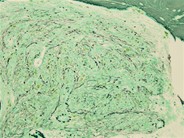 Bone Marrow Fibrosis - 2.