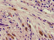 Bone Marrow Fibrosis - 4.