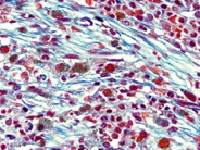 Bone Marrow Fibrosis - 6.