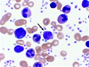 Sézary Cells - 2.