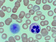 Dohle Bodies in the May-Hegglin Anomaly - 2.