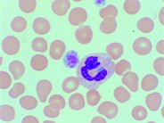 Dohle Bodies in the May-Hegglin Anomaly - 3.