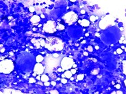 Megakaryocytic Hyperplasia - 1.