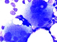 Megakaryocytic Hyperplasia - 2.