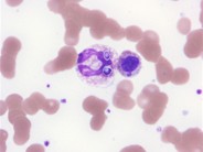 Histoplasma Capsulatum WBC Inclusions - 2.