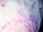 Leukemia Cutis - 2.