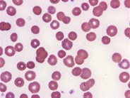 Basophilic Stippling - 1.